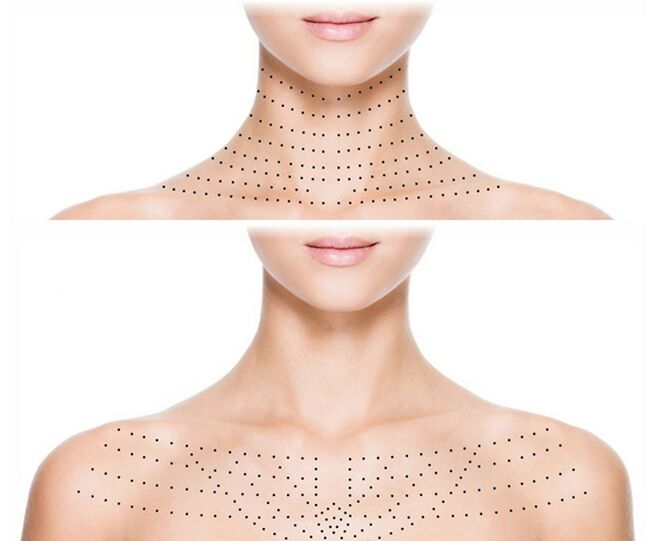 Merking på huden på halsen og dekolletage for foryngende biorevitalisering