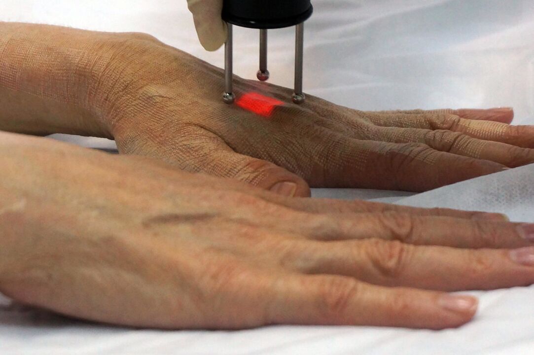 Laserforyngelse av hendene med en ikke-ablativ metode