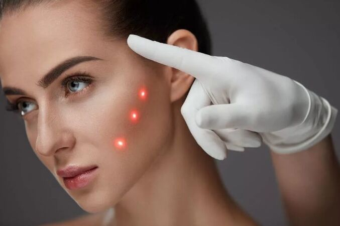 Laserforyngelse av huden