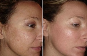 laser ansiktshudforyngelse før og etter bilder